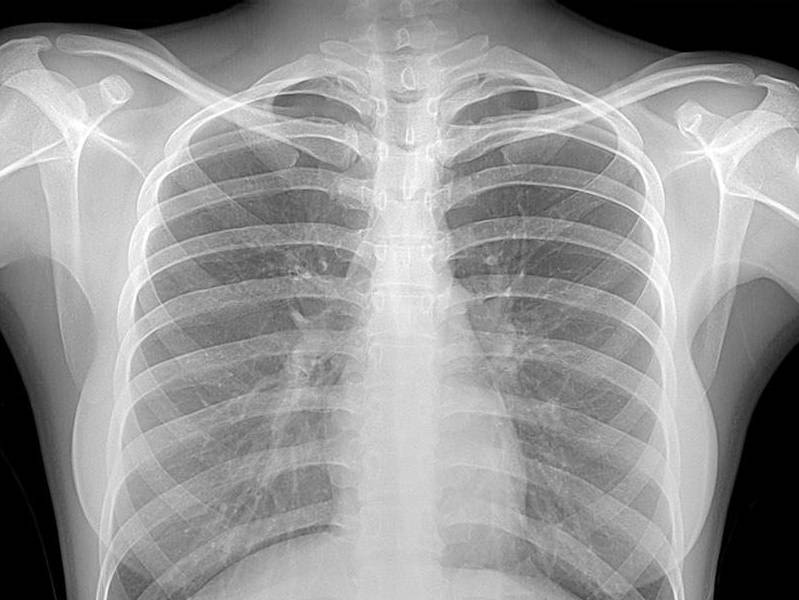 Chest X-Ray